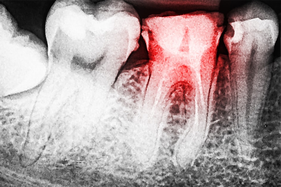 Dentoalveolar Trauma