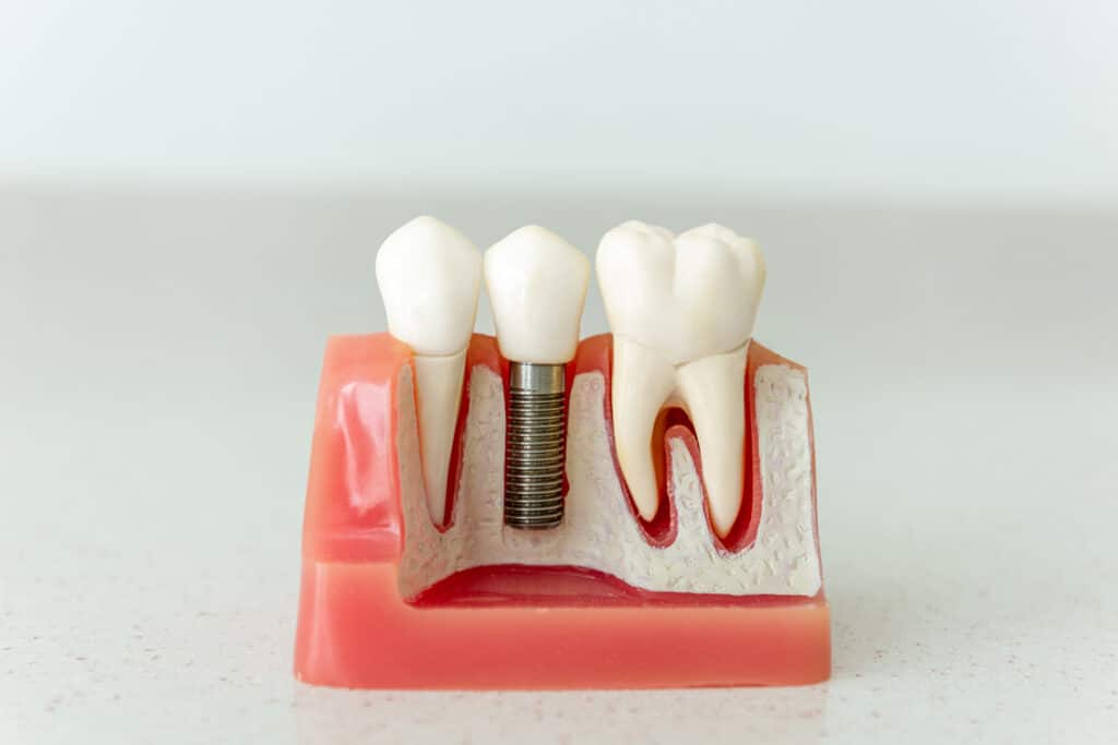Are Dental Implants a Good Option After Long Term Tooth Loss?