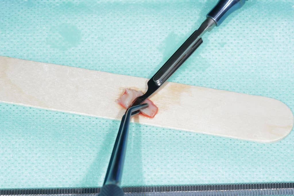 How to Prepare for Bone Grafting Surgery in Cincinnati: A Patient's Checklist