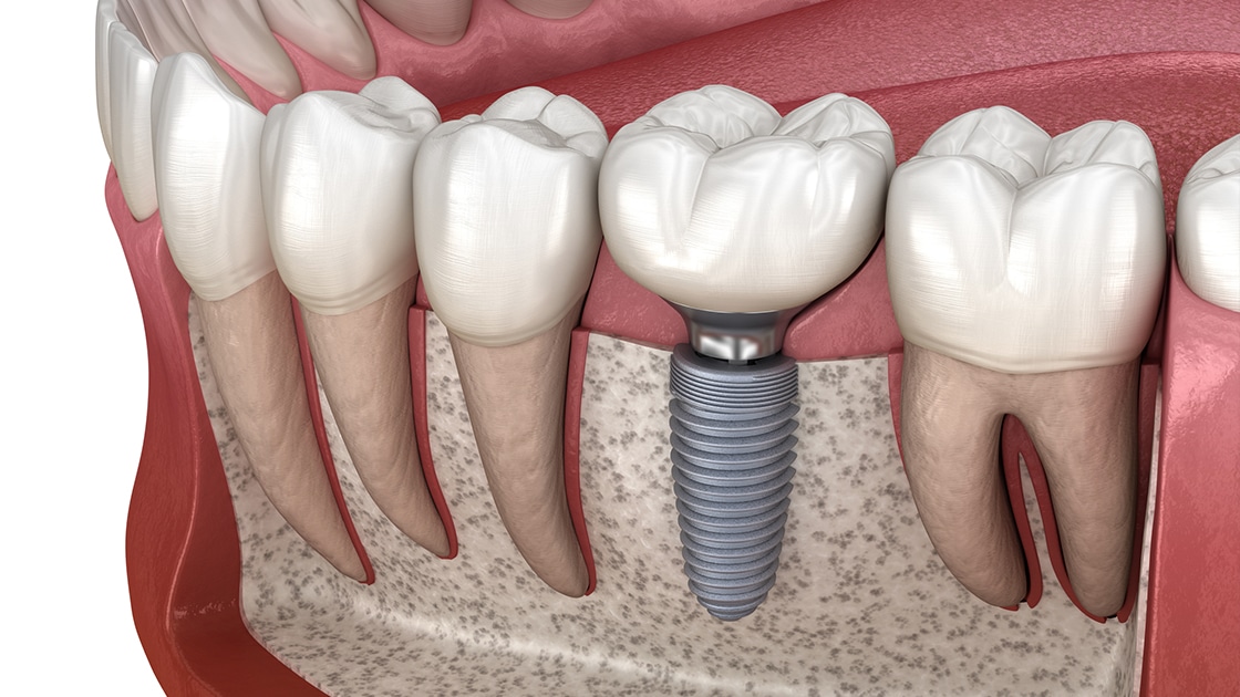 Dental Implants - Couple Walking