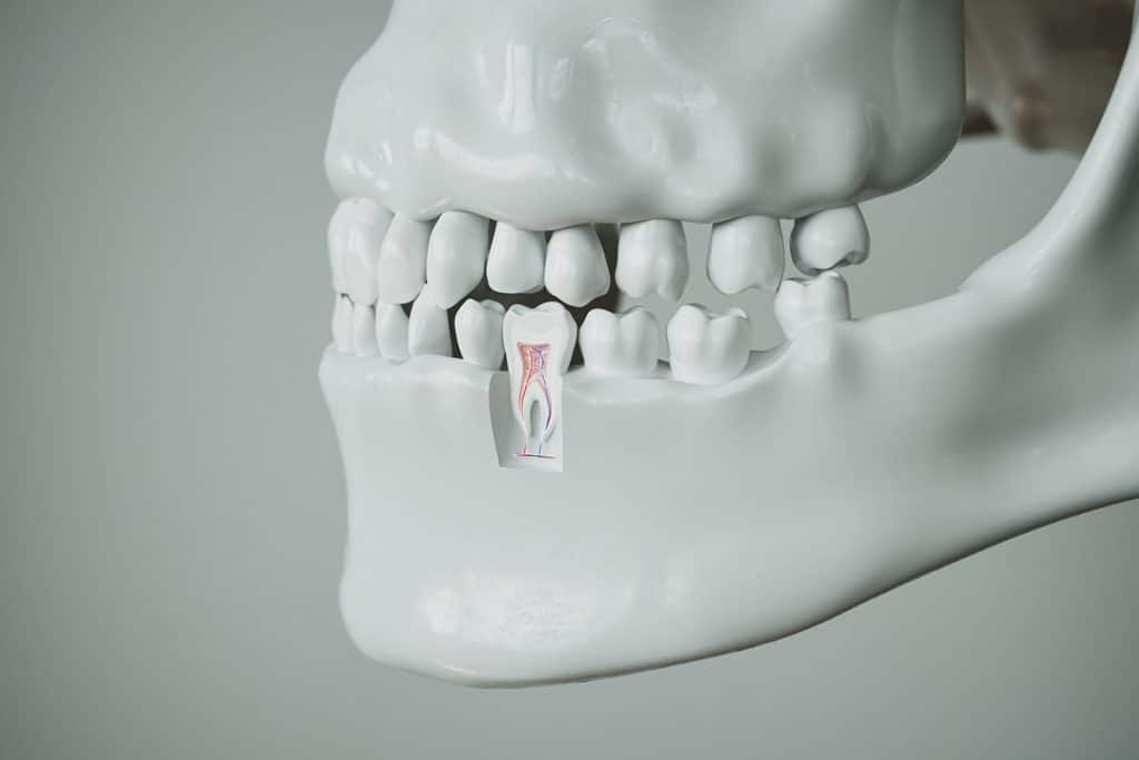 The Link Between Sinus Lifts and Bone Grafting for Upper Jaw Implants