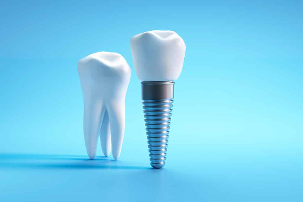 What Happens If You Delay Replacing a Missing Tooth With an Implant?