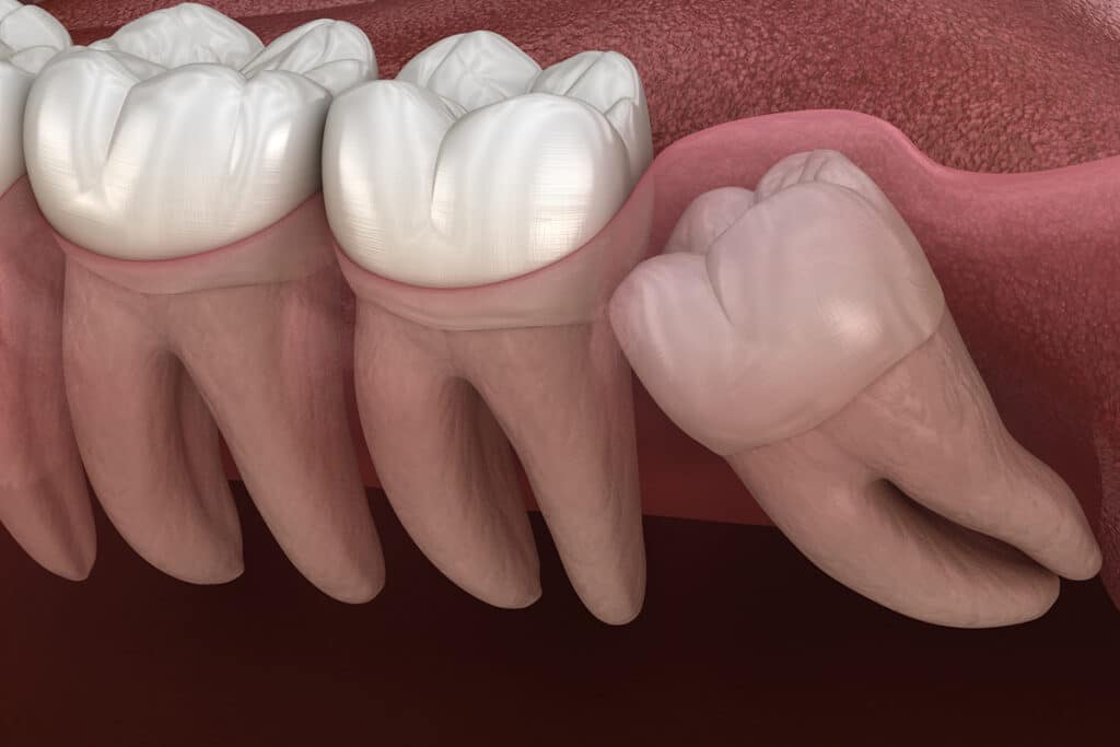 Wisdom Teeth and Sinus Issues: The Connection Cincinnati Patients Should Know About