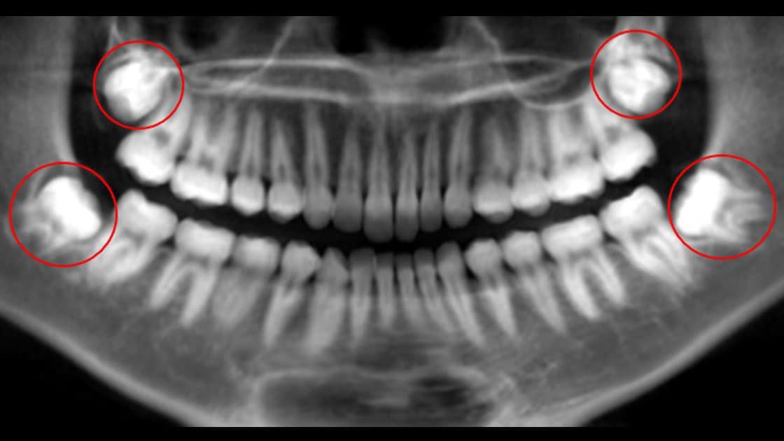 Wisdom Teeth - Smiling Patient