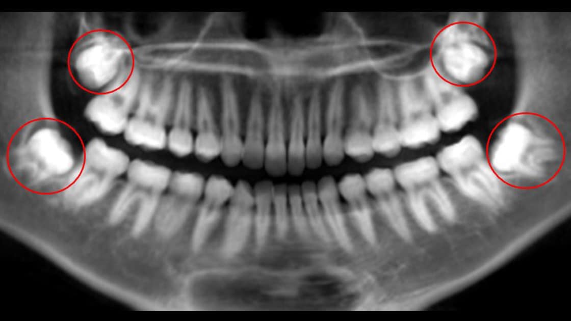 xray showing impacted wisdom teeth